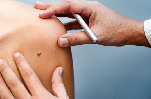 Cáncer de piel: a mayor edad, mayor riesgo CANCER DE PIEL