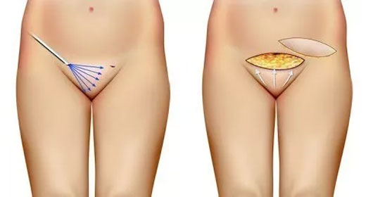 Cirug&iacute;a &iacute;ntima femenina