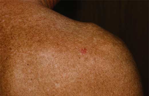 DA&Ntilde;O ACTINICO: CARCINOMA