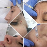 Agosto: curso presencial de Armonizaci�n Panfacial