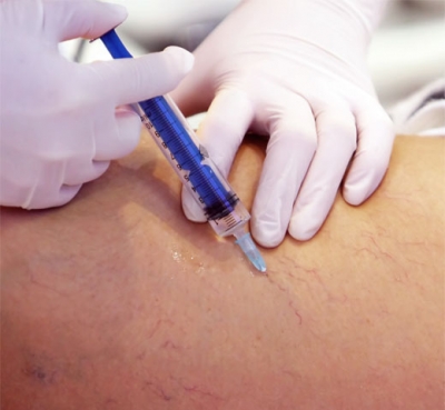 Eliminaci�n de ara�as vasculares mediante esclerosis qu�mica